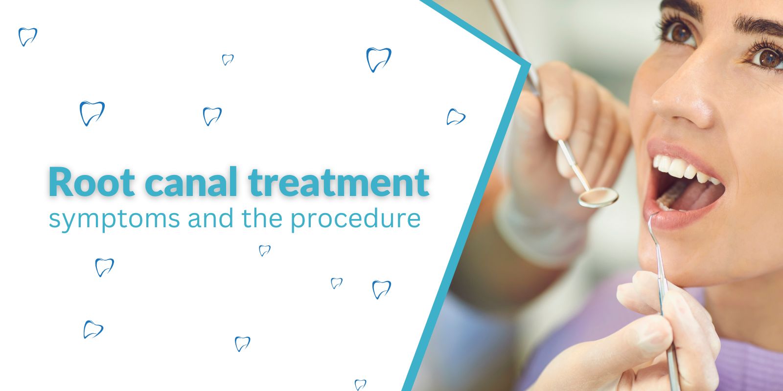 Root canal treatment – symptoms and the procedure